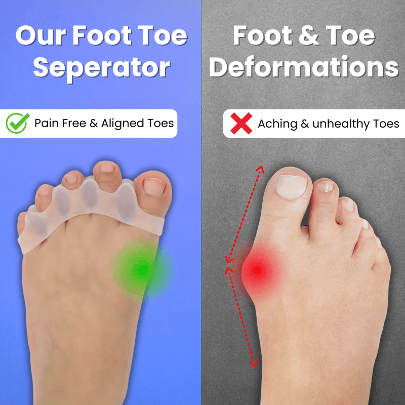 Strivon Toe Align – Foot Toe Separator for Bunions & Hammer Toes