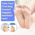 Strivon Toe Align – Foot Toe Separator for Bunions & Hammer Toes